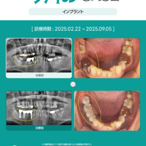 25.09.29 아마노치과_안내문_이달의 케이스(인스타)