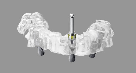 オーダーメイドのインプラントガイド製作